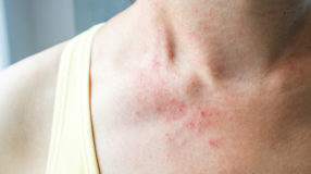 Dermatitis herpetiformis